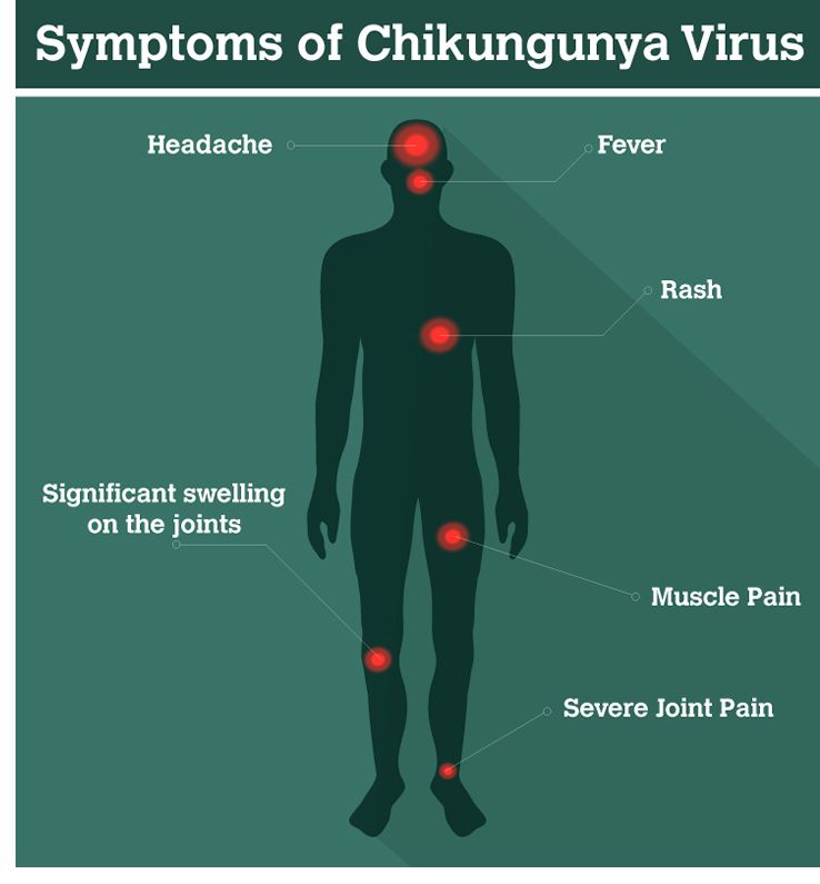 Triệu chứng Chikungunya